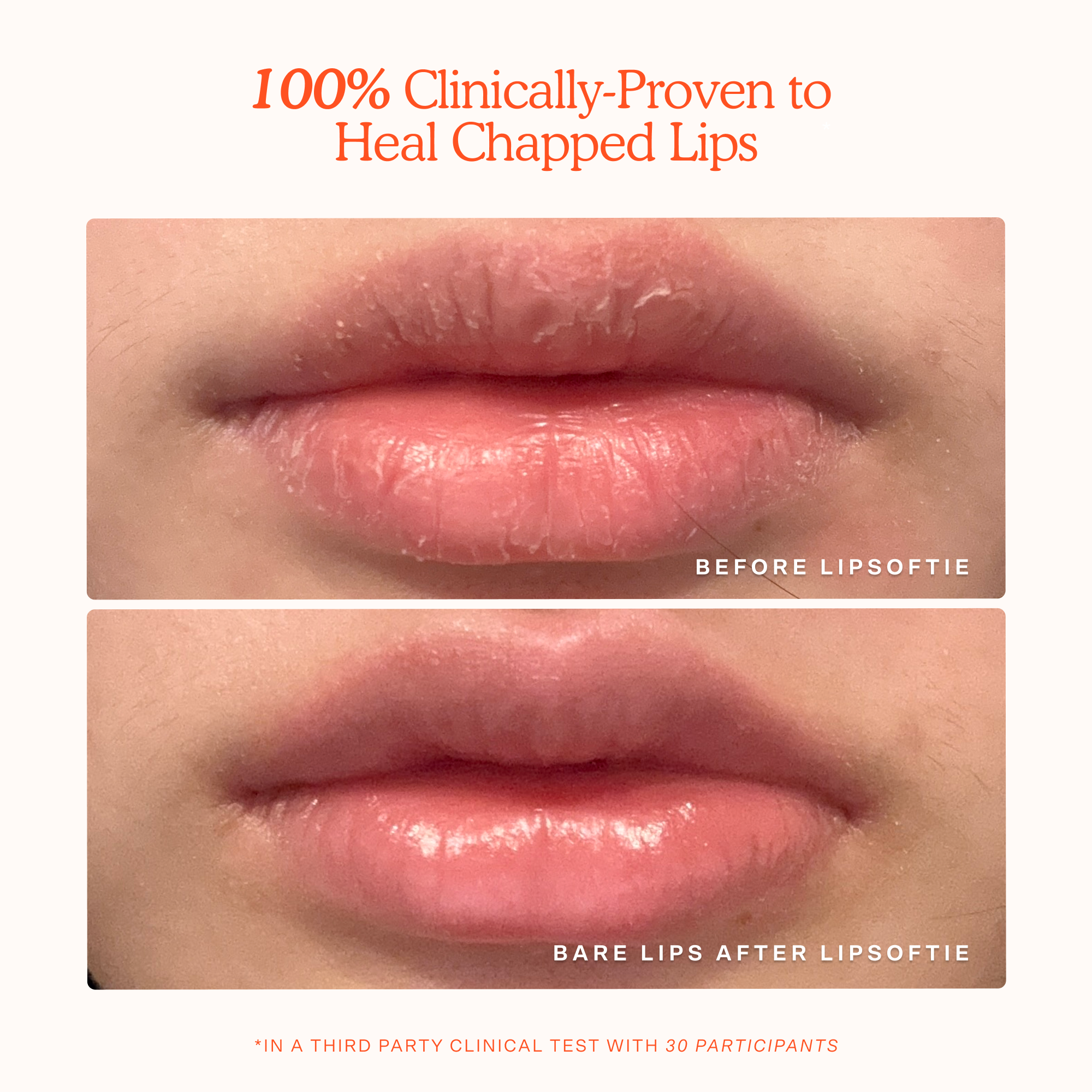 LipSoftie® Nourishing lip treatment