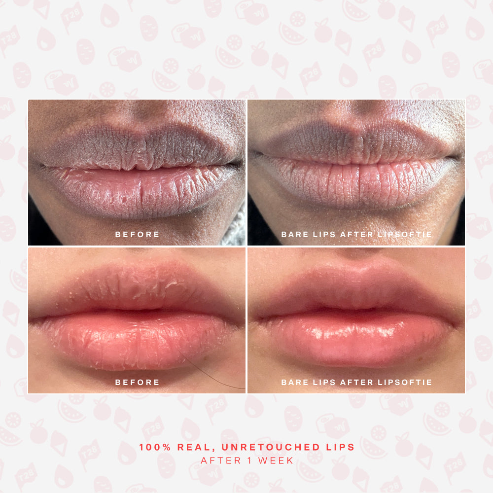 SOS LipSoftie® Nourishing lip treatment