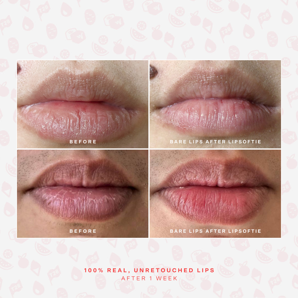 SOS LipSoftie® Nourishing lip treatment